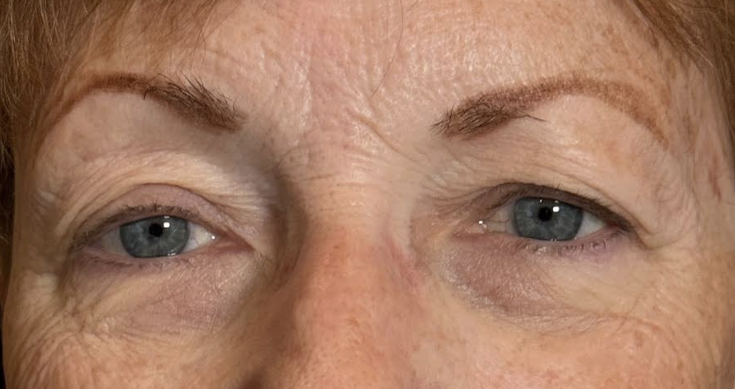 Conservative MMCR to mitigate Ptosis and Symmetrize Eyelids (2 weeks Post OP) Before