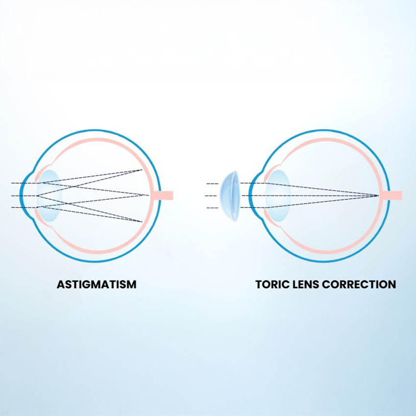 Specialty-Soft-Contact-Lenses