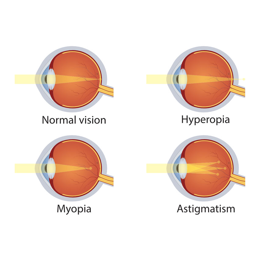 Understanding-refractive-errors