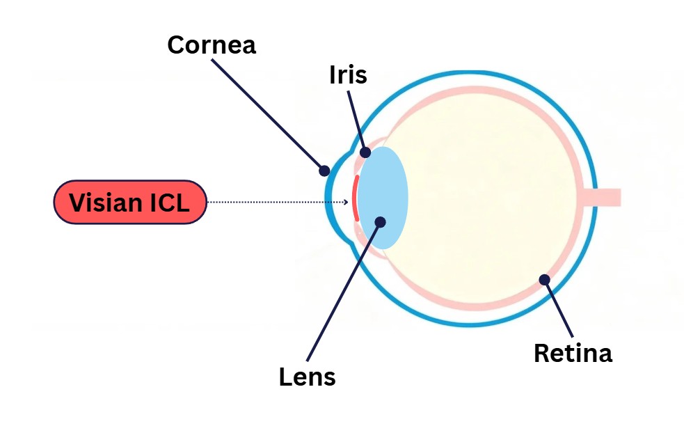 Visian ICL