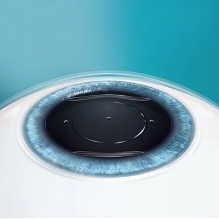 What to Expect During the Evo Visian ICL Procedure