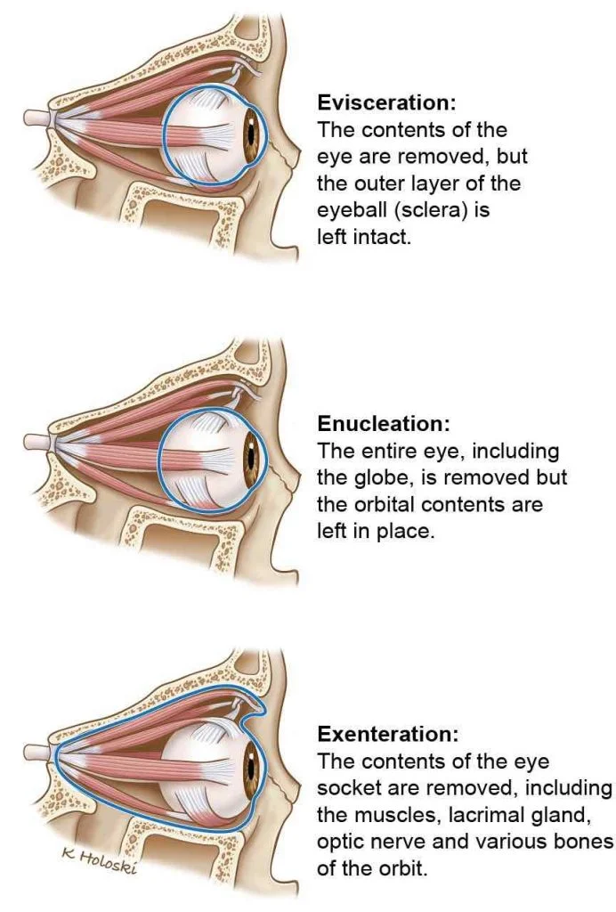 82_eye_removal_surgeries-692x1024