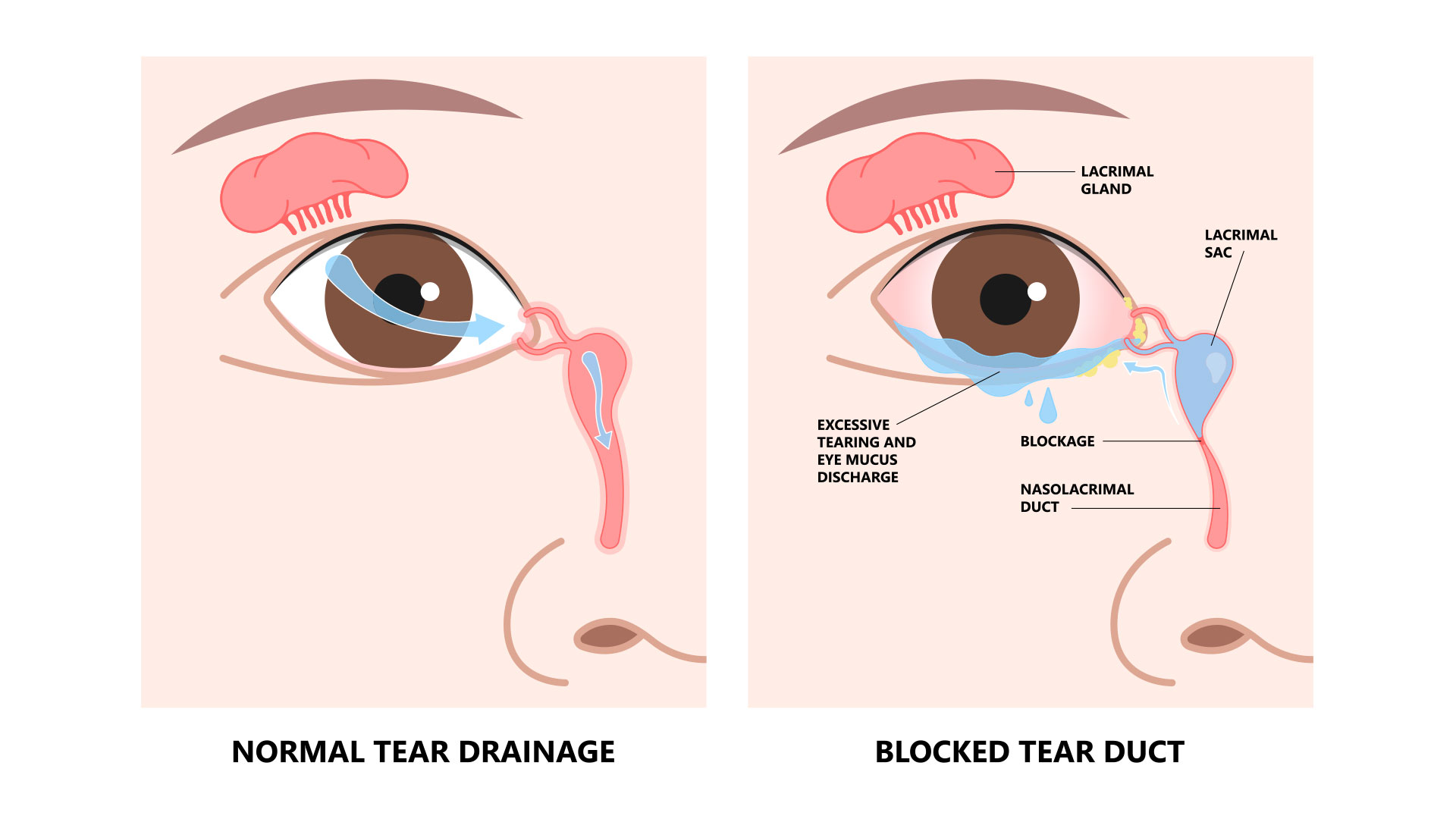 Blocked-tear-duct-eye-sinus-toddler-red-dry-swollen-nasal-nose-pain-eyelid-Gland-medial-system-drain