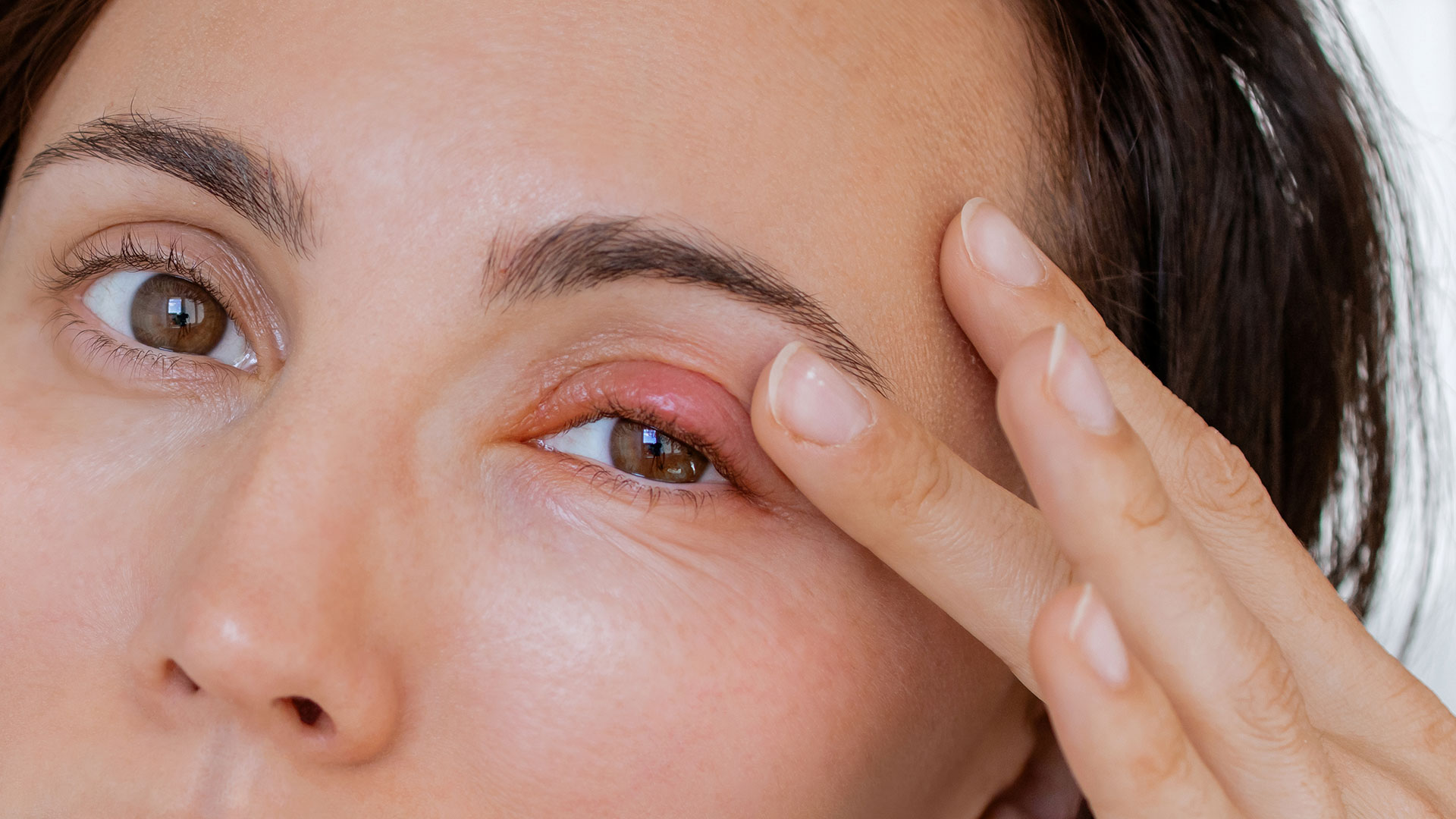 Close-up-female-patient's-infected-eye.-The-brown-eyed-woman-staring-at-the-camera-has-an-external-stye-bacterial-infection