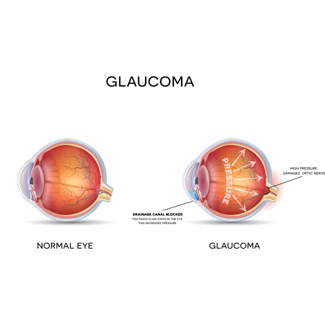 Glaucoma-and-healthy-eye-detailed-structure.1
