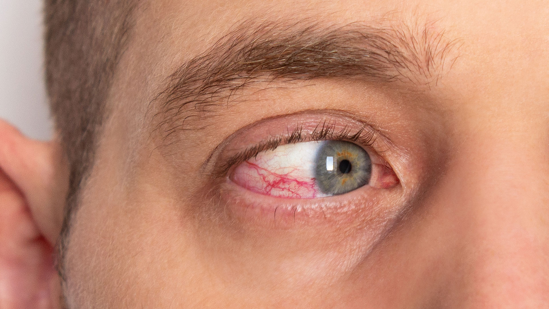 Red-male-eye-with-damaged-blood-vessels-close-up.-Retinal-diseases-after-injury
