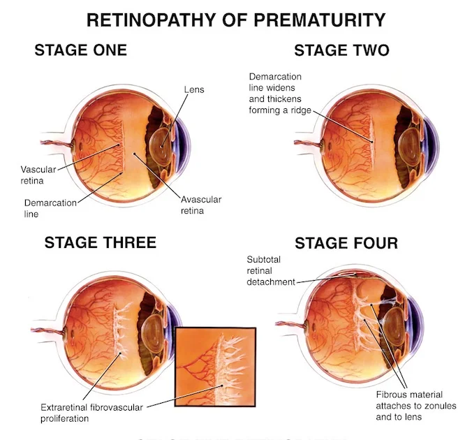 Retinopathy