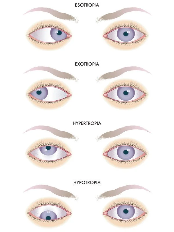 Strabismus-type-diagram