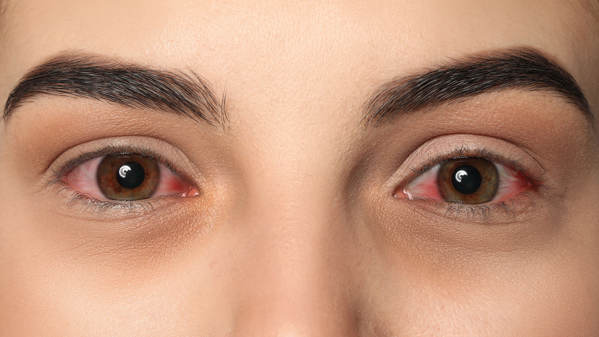 Woman-with-red-eyes-suffering-from-conjunctivitis,-closeup