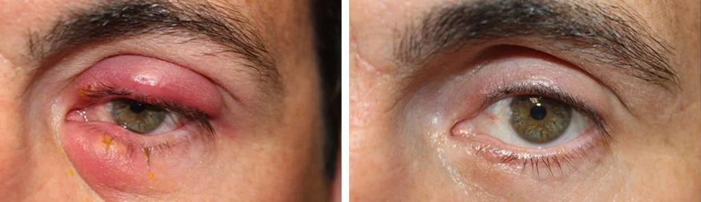 before-after-chalazion-7-1024x295