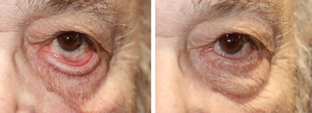 before-after-eyelid-repaid-11-1024x373