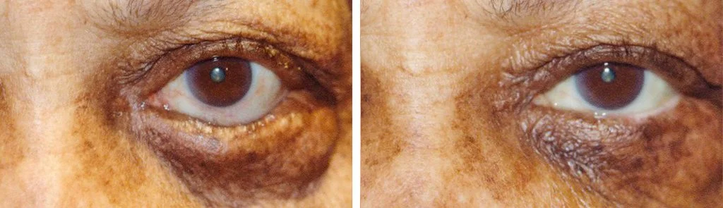 before-after-eyelid-repair-10-1024x295