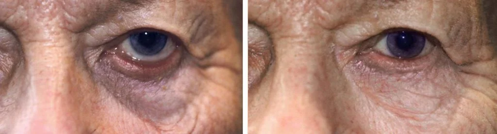 before-after-eyelid-repair-12-1024x277