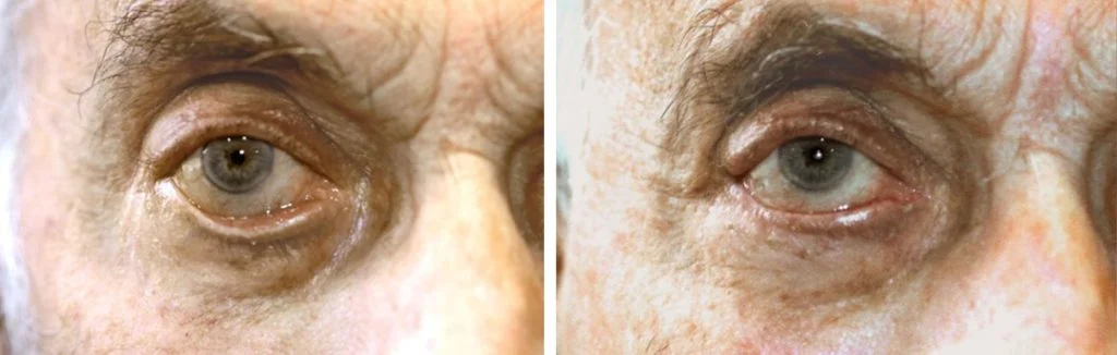 before-after-eyelid-repair-13-1024x326