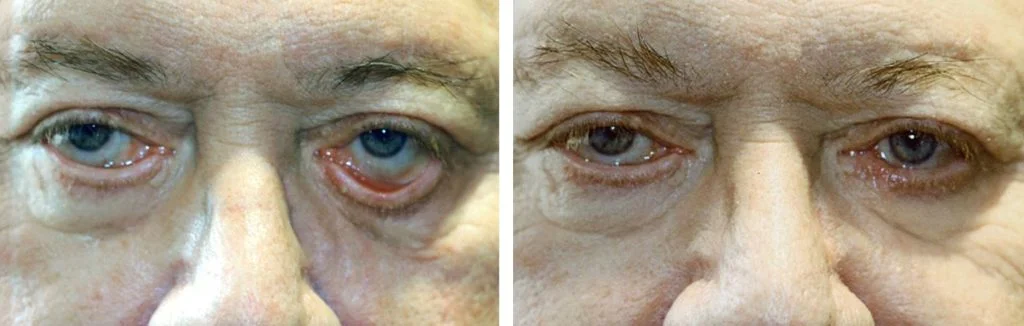 before-after-eyelid-repair-14-1024x326