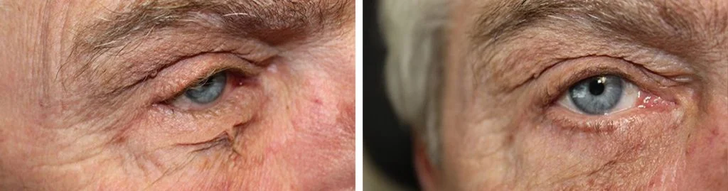 before-after-eyelid-repair-3-1024x269