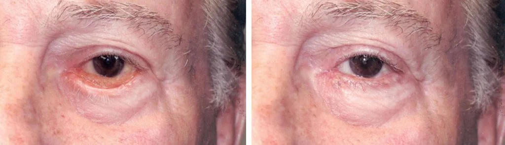 before-after-eyelid-repair-6-1024x295