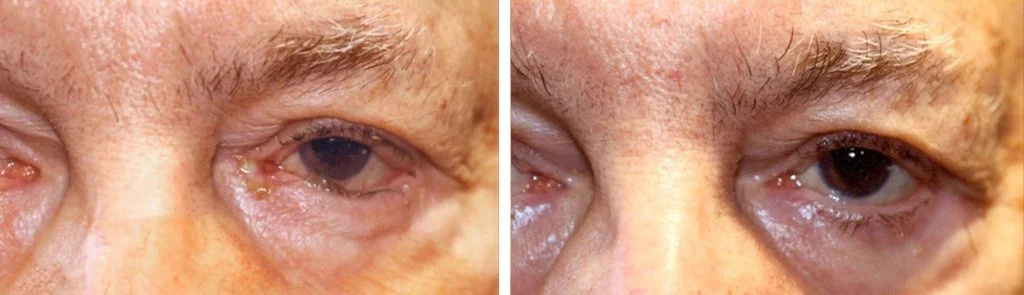 before-after-eyelid-repair-9-1024x295