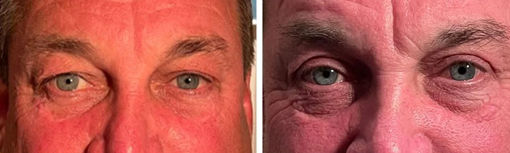 blepharoplasty-before-after-1-1-1024x307