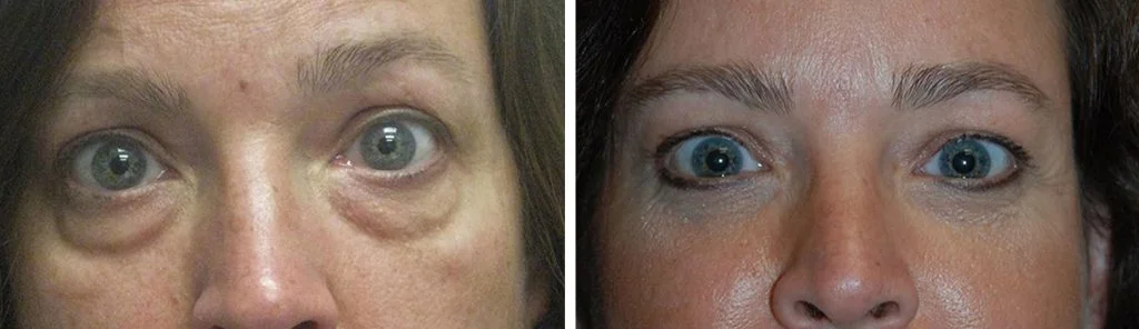 blepharoplasty-before-after-10-1024x296