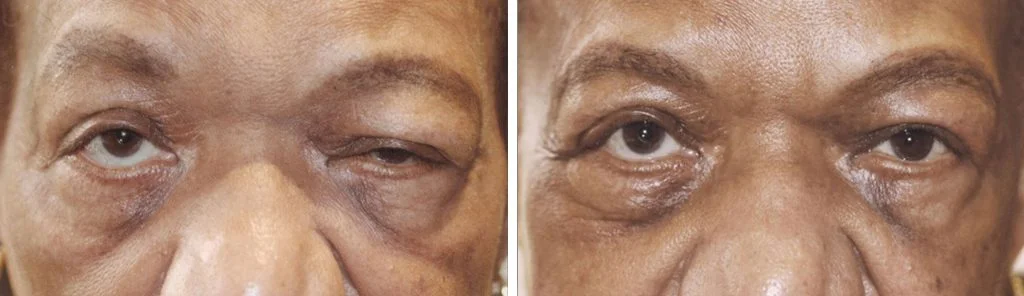 blepharoplasty-before-after-11-1024x296