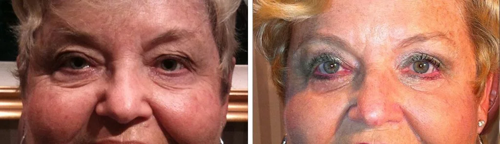 blepharoplasty-before-after-12-1024x296
