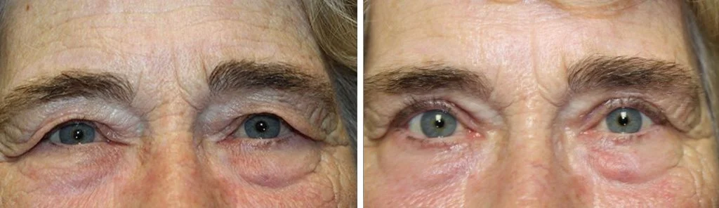 blepharoplasty-before-after-14-1024x296