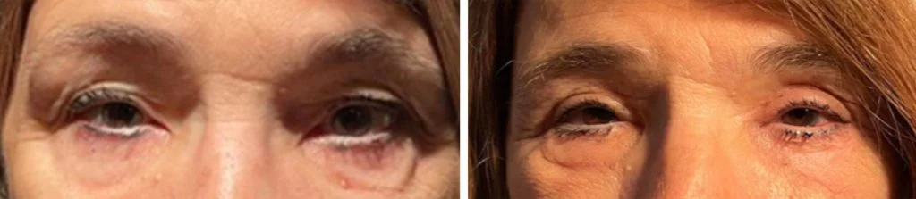 blepharoplasty-before-after-3-1024x223