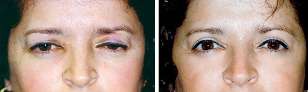 blepharoplasty-before-after-4-1024x308