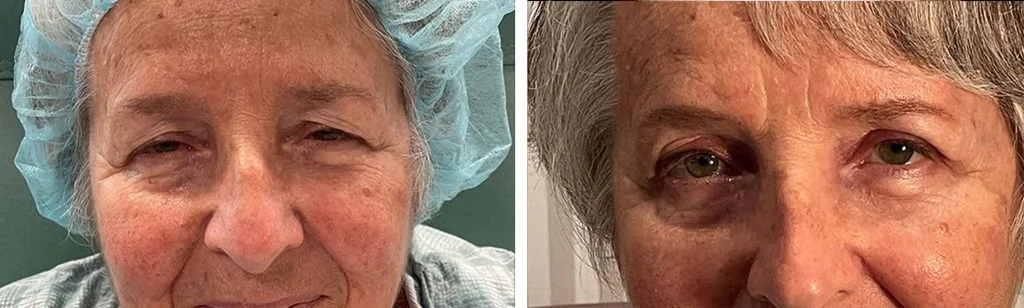 blepharoplasty-before-after-5-1024x308