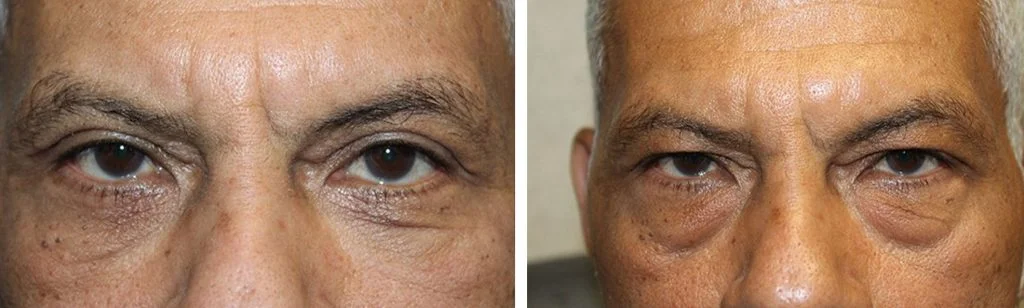 blepharoplasty-before-after-6-1024x308