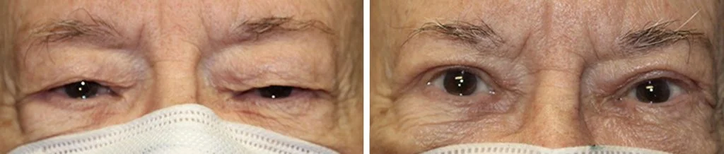 blepharoplasty-before-after-7-1024x218