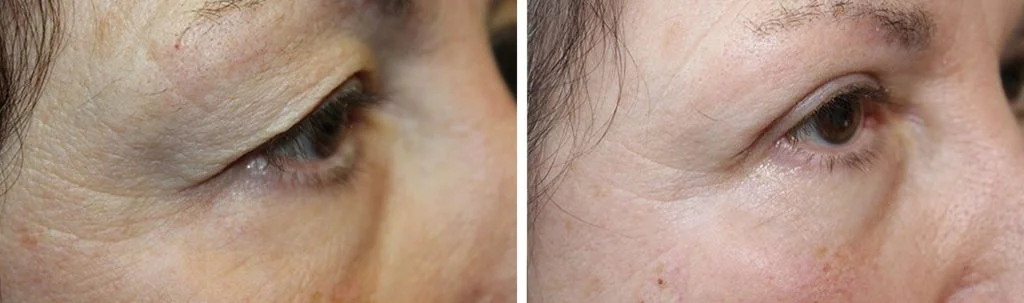 blepharoplasty-before-after-8-1024x303