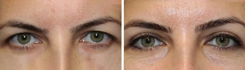 blepharoplasty-before-after-9-1024x296