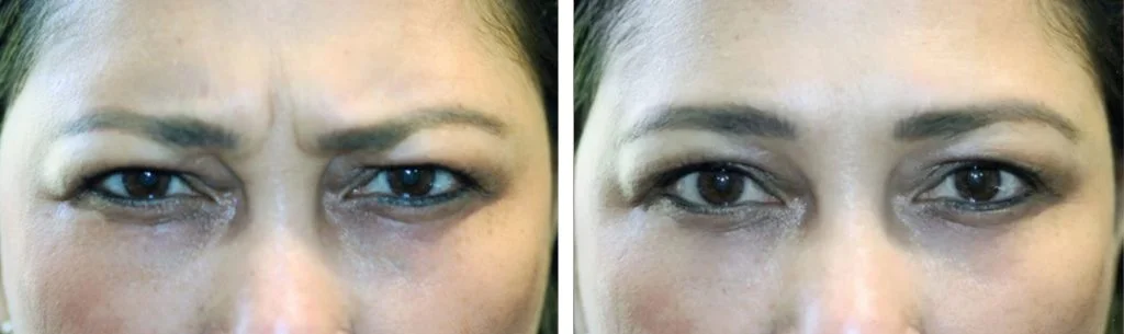 botox-before-after-1-1024x305