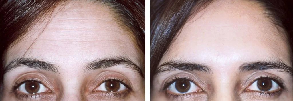 botox-before-after-10-1024x353