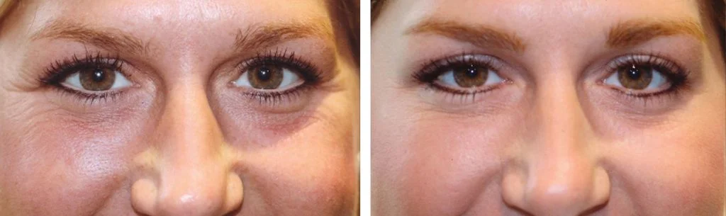 botox-before-after-11-1024x305