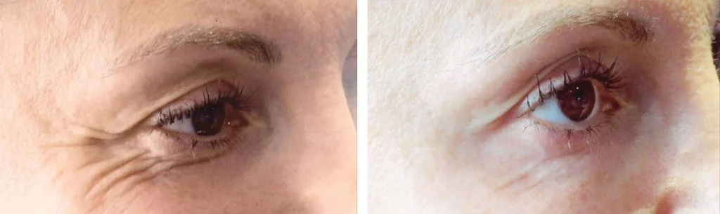 botox-before-after-12-1024x305