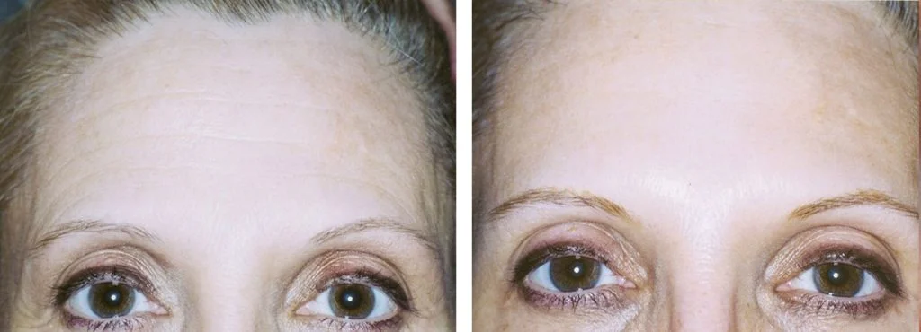 botox-before-after-13-1024x370