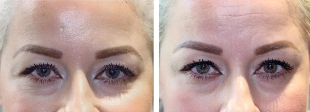 botox-before-after-14-1024x370