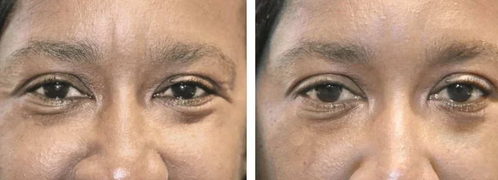 botox-before-after-15-1024x370