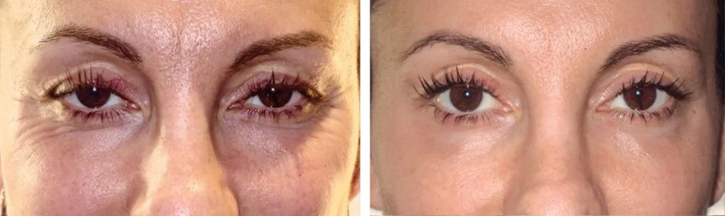 botox-before-after-2-1024x305