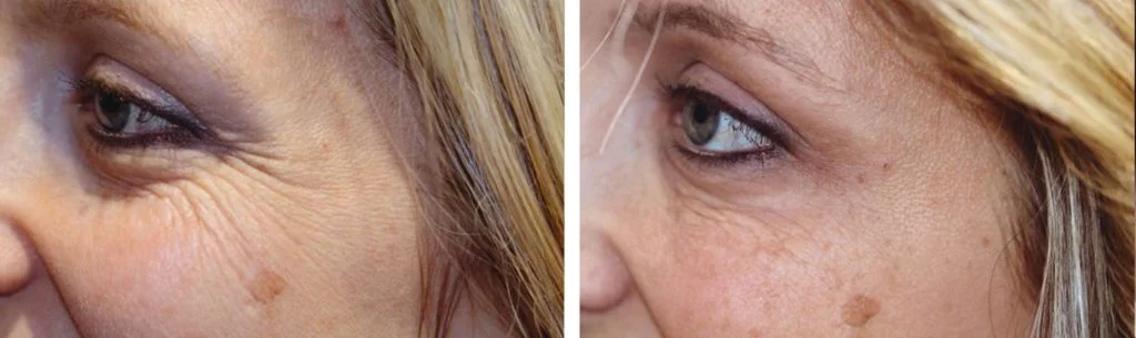 botox-before-after-3-1024x305