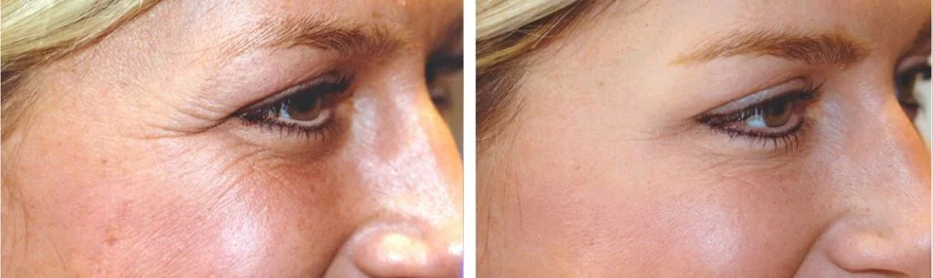 botox-before-after-4-1024x3052