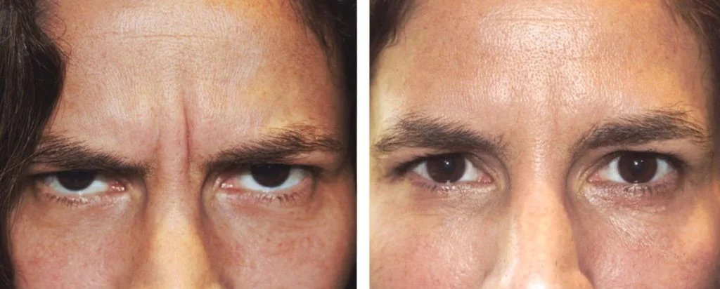 botox-before-after-6-1024x412