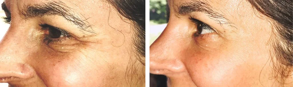 botox-before-after-7-1024x305