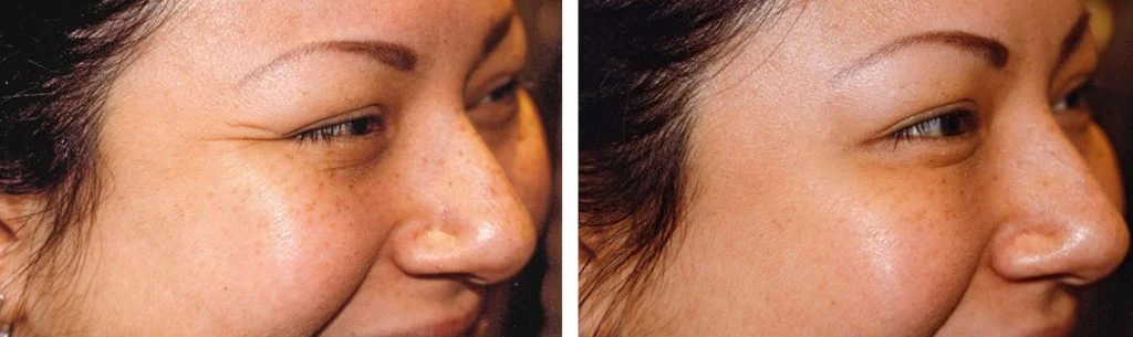 botox-before-after-8-1024x305
