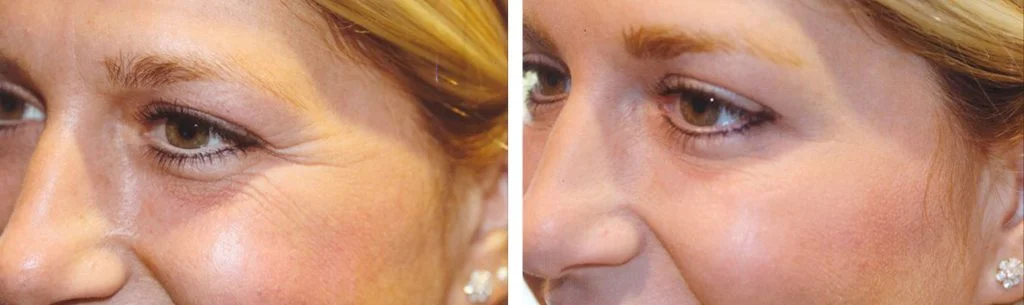 botox-before-after-9-1024x305