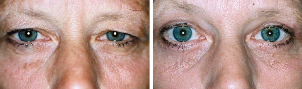 brow-lift-before-and-after-1-2-1024x303