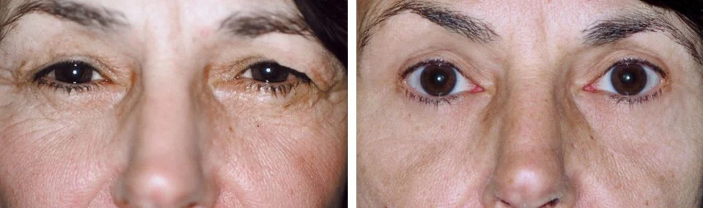 brow-lift-before-and-after-3-1-1024x303